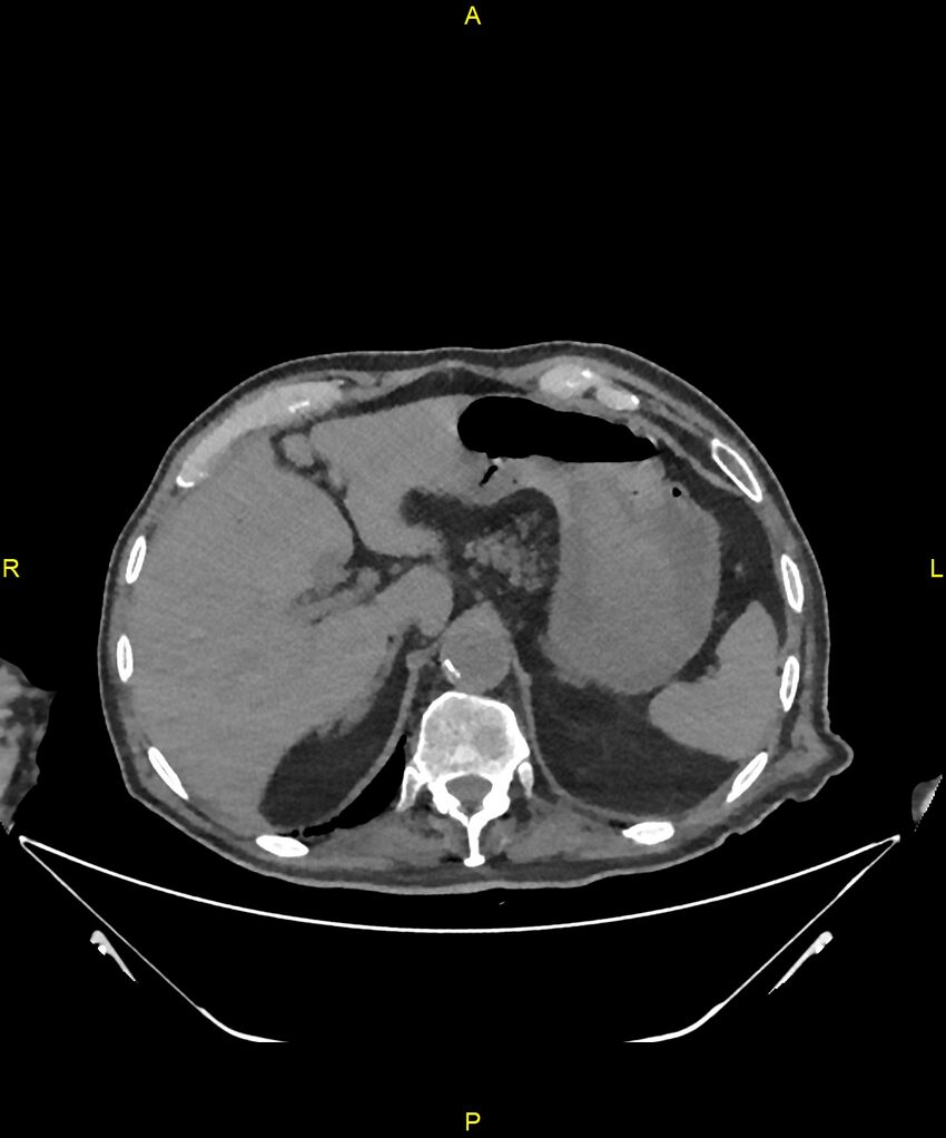 Aortoenteric fistula (Radiopaedia 84308-99603 Axial non-contrast 63).jpg