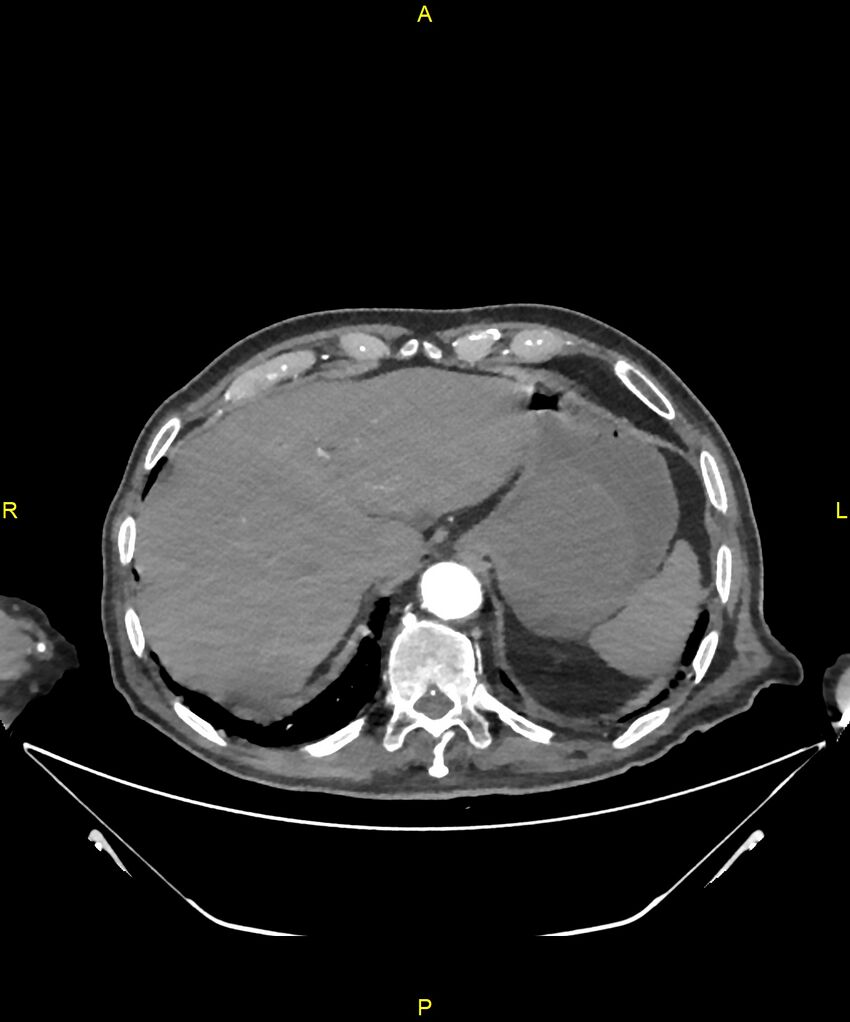 Aortoenteric fistula (Radiopaedia 84308-99603 B 41).jpg