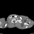 Aortopulmonary window, interrupted aortic arch and large PDA giving the descending aorta (Radiopaedia 35573-37074 B 1).jpg