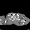 Aortopulmonary window, interrupted aortic arch and large PDA giving the descending aorta (Radiopaedia 35573-37074 B 2).jpg