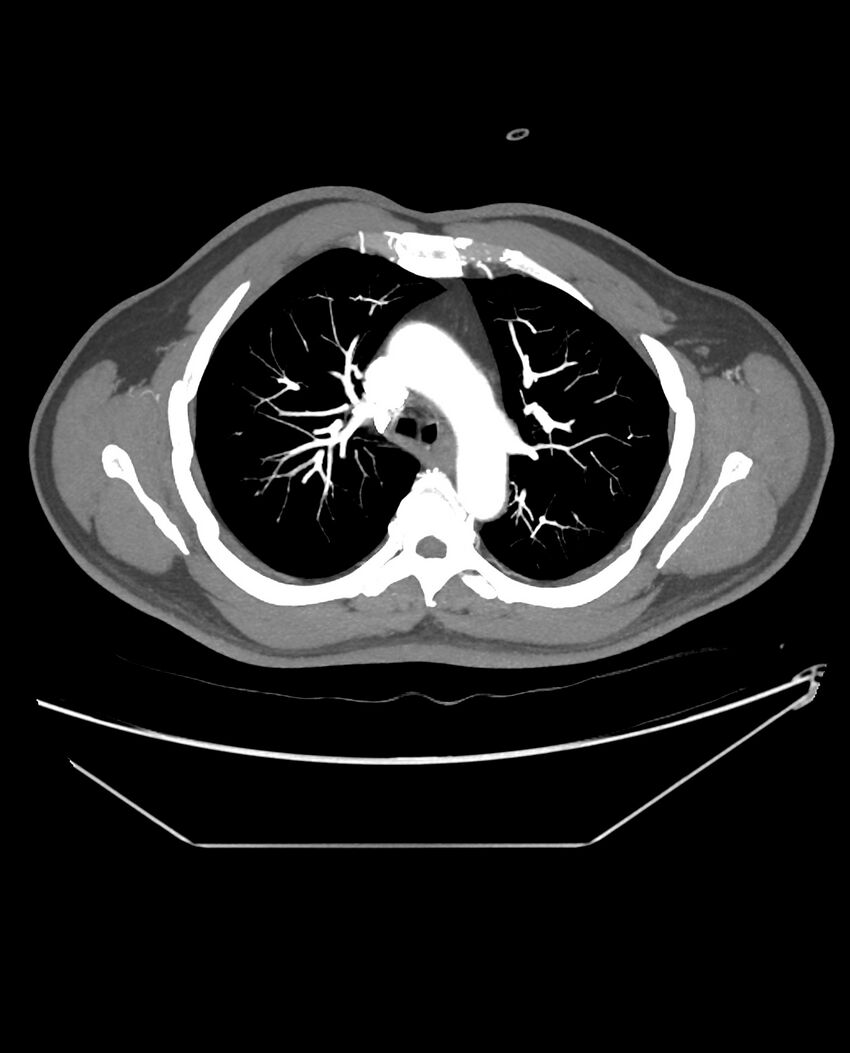 Aplastic posterior tibial arteries (Radiopaedia 84021-99249 A 10).jpg