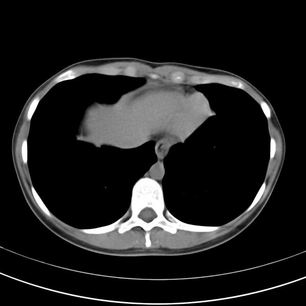 File:Appendicitis and incidental bicornuate uterus (Radiopaedia 22833-22853 Axial non-contrast 5).jpg