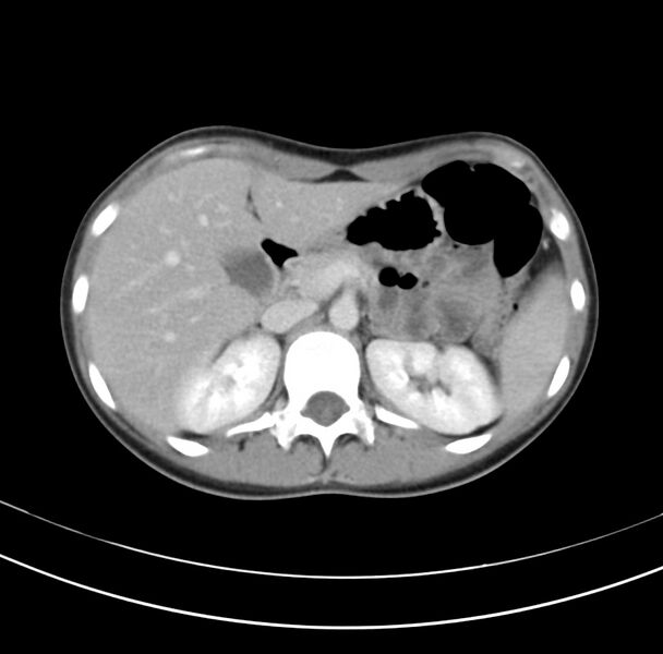 File:Appendicitis and incidental bicornuate uterus (Radiopaedia 22833-22853 B 12).jpg