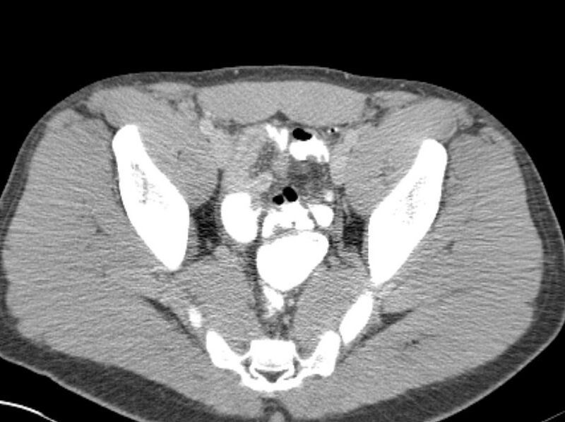 File:Appendicitis and incidental foregut duplication cyst (Radiopaedia 52962-58916 A 86).jpg