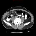 Appendicitis and renal cell carcinoma (Radiopaedia 17063-16760 A 37).jpg