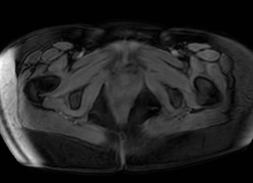 Appendicitis in gravida (MRI) (Radiopaedia 89433-106395 Axial DIXON 152).jpg
