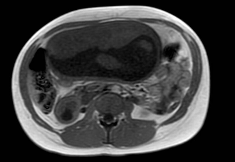 File:Appendicitis in gravida (MRI) (Radiopaedia 89433-106395 Axial T1 in-phase 30).jpg