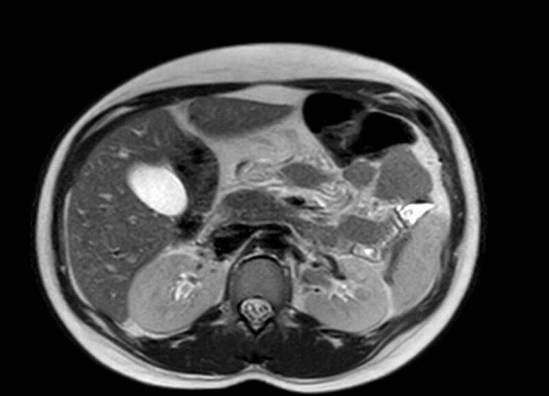 File:Appendicitis in gravida (MRI) (Radiopaedia 89433-106395 Axial T2 21).jpg