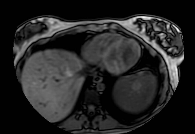 File:Appendicitis in gravida (MRI) (Radiopaedia 89433-106395 D 1).jpg