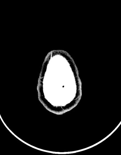 File:Arrow injury to the brain (Radiopaedia 72101-82607 Axial non-contrast 93).jpg