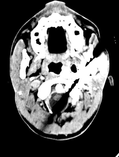 File:Arrow injury to the face (Radiopaedia 73267-84011 Axial C+ delayed 29).jpg