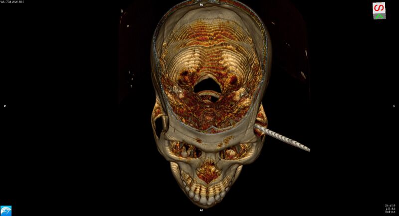 File:Arrow injury to the head (Radiopaedia 75266-86388 3D vertical 15).jpg