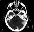 Arteriovenous malformation - cerebral (Radiopaedia 8172-14682 A 4).jpg