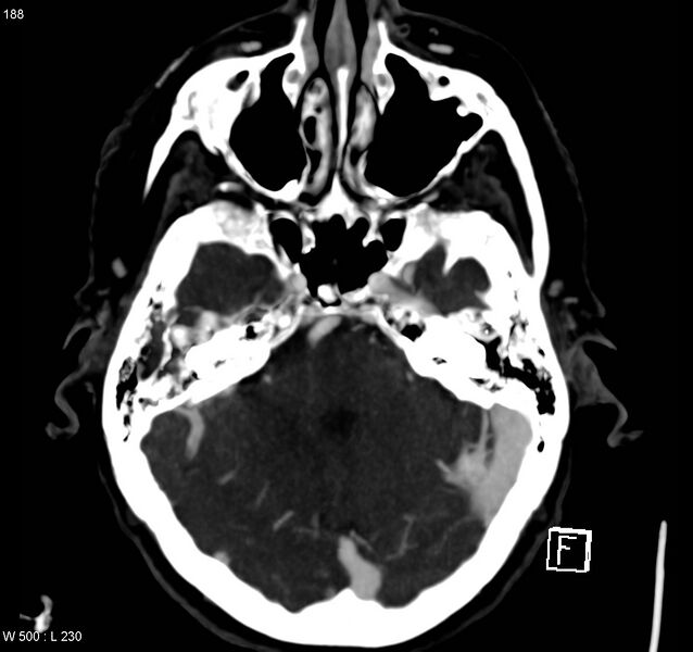 File:Arteriovenous malformation - cerebral (Radiopaedia 8172-14682 A 4).jpg