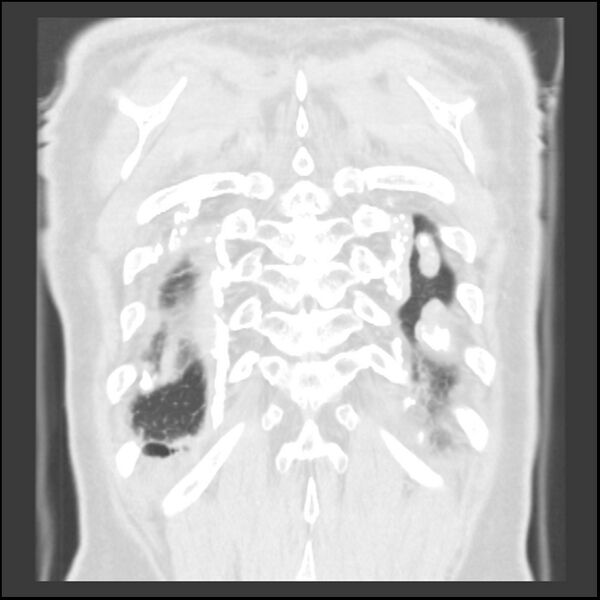 File:Asbestos-related pleural plaques (Radiopaedia 39069-41255 Coronal lung window 8).jpg
