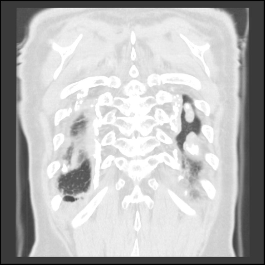 Asbestos-related pleural plaques (Radiopaedia 39069-41255 Coronal lung window 8).jpg