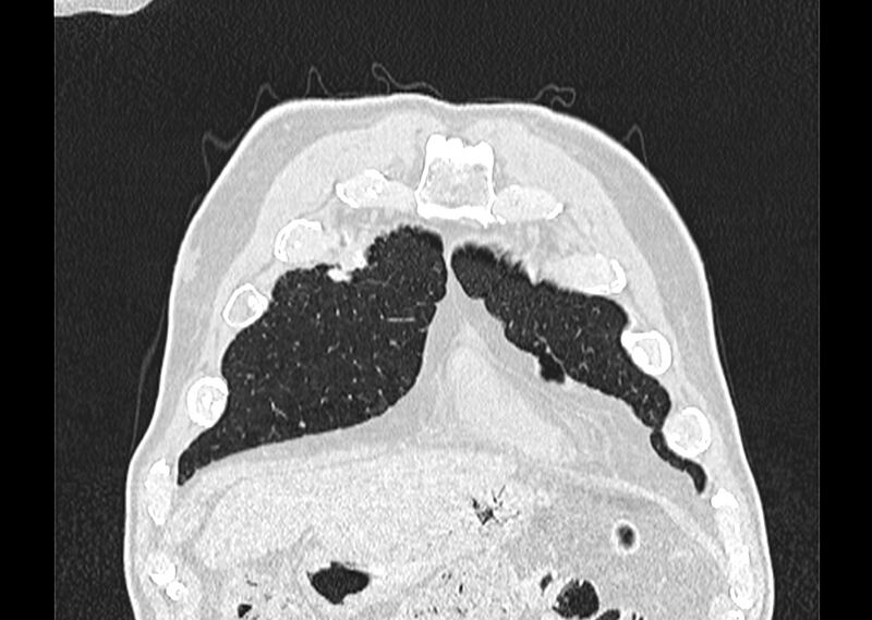 File:Asbestos pleural placques (Radiopaedia 57905-64872 Coronal lung window 25).jpg