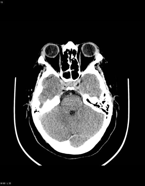 File:Astroblastoma (Radiopaedia 39792-42216 Axial non-contrast 14).jpg