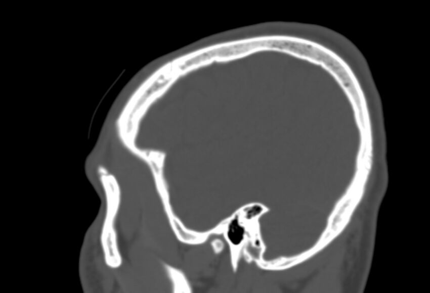 Asymptomatic occipital spur (Radiopaedia 87753-104201 Sagittal bone window 259).jpg