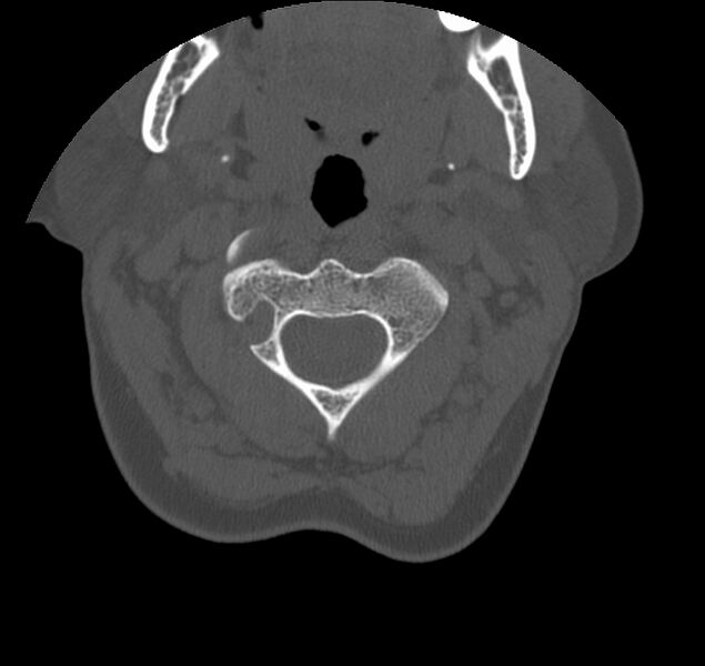File:Atlanto-occipital assimilation with basilar invagination (Radiopaedia 70122-80188 Axial bone window 37).jpg