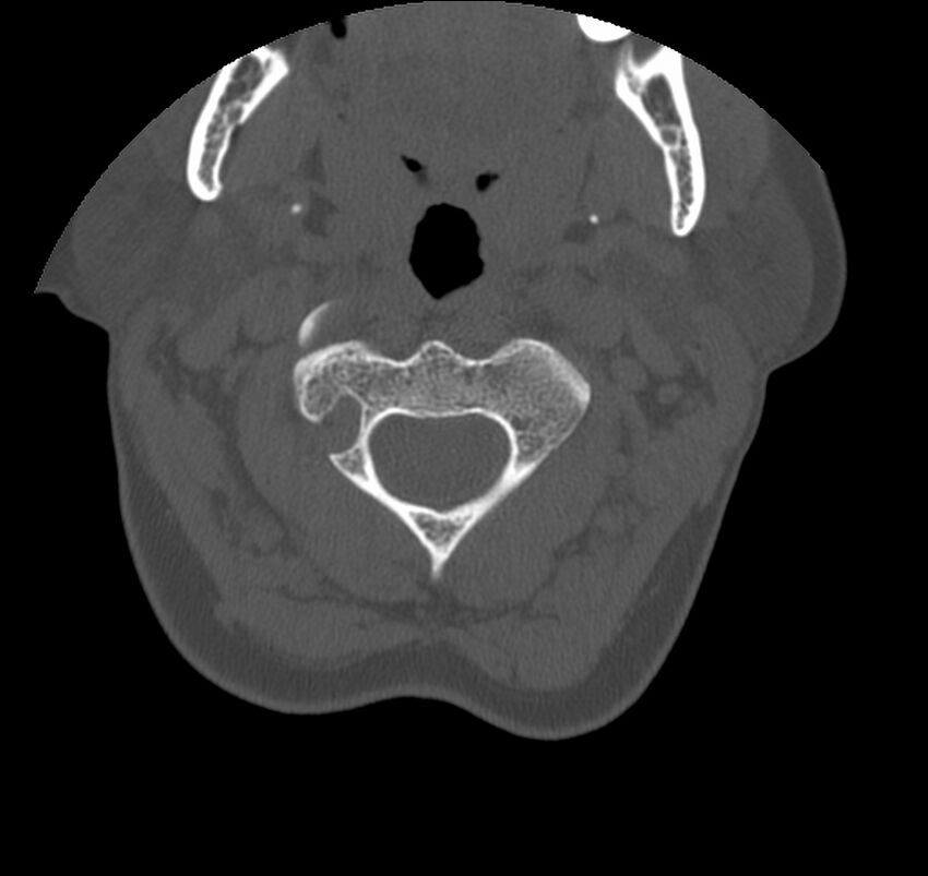 Atlanto-occipital assimilation with basilar invagination (Radiopaedia 70122-80188 Axial bone window 37).jpg