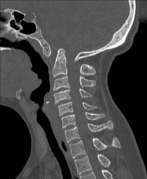 File:Atlanto-occipital assimilation with basilar invagination (Radiopaedia 70122-80188 Sagittal bone window 60).jpg