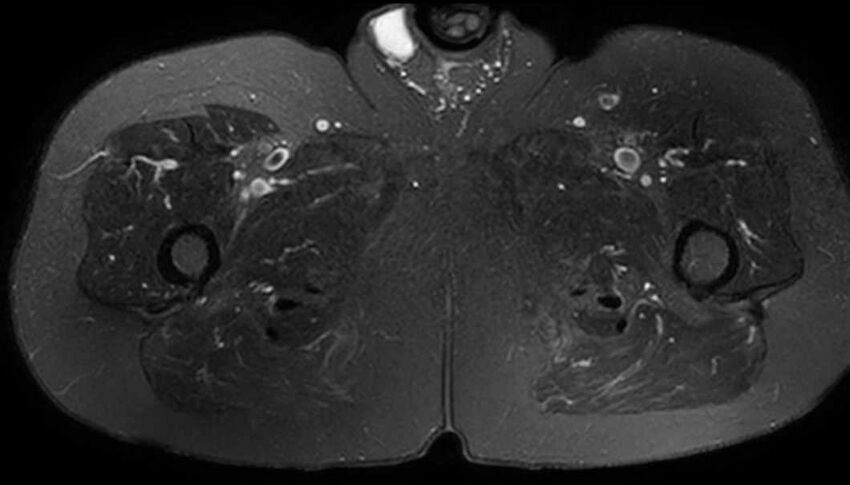 Atypical lipomatous tumor - thigh (Radiopaedia 68975-78734 Axial T2 fat sat 76).jpg
