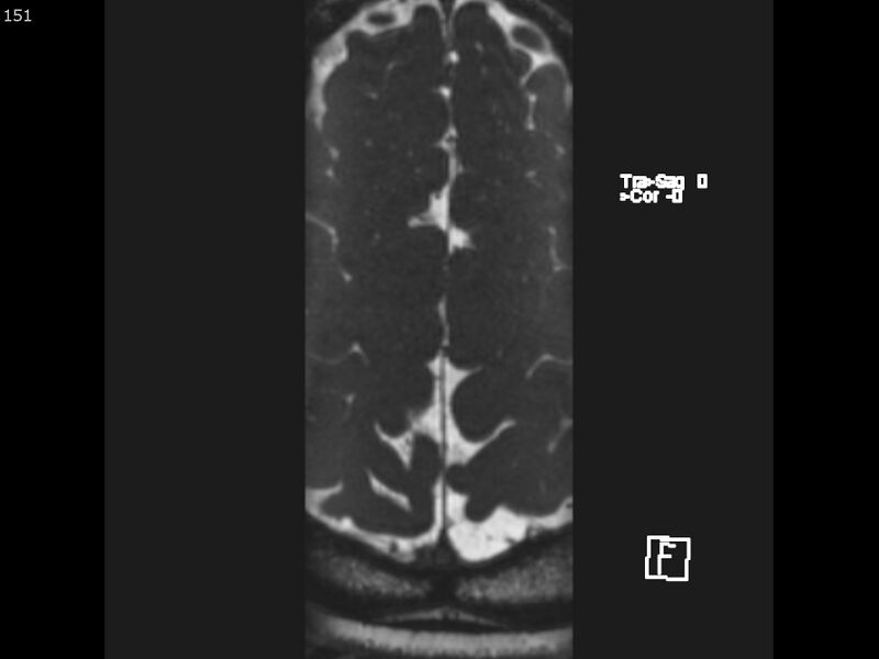 File:Atypical meningioma - intraosseous (Radiopaedia 64915-74572 Axial CISS 151).jpg