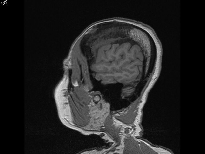 Atypical meningioma - intraosseous (Radiopaedia 64915-74572 Sagittal T1 126).jpg