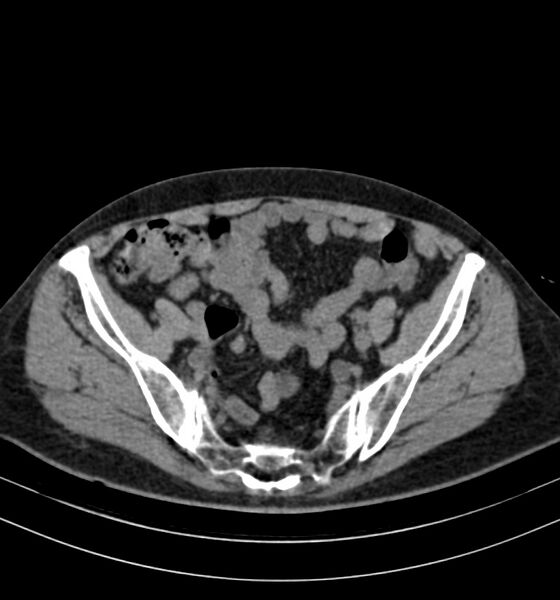 File:Autosomal dominant polycystic kidney disease (Radiopaedia 41918-44922 Axial non-contrast 28).jpg