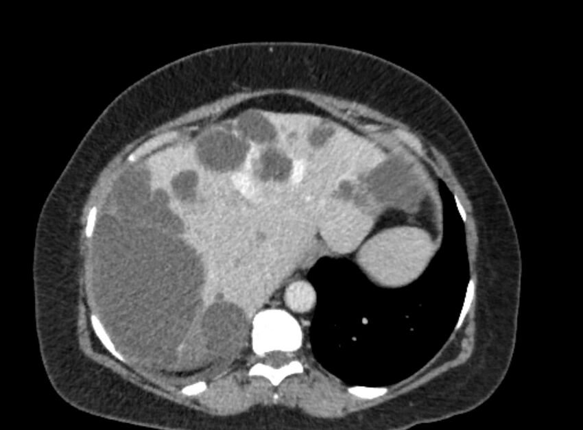 Autosomal dominant polycystic kidney disease (Radiopaedia 57124-64017 A 25).jpg