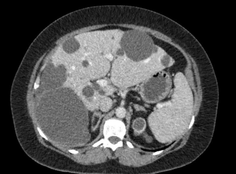 File:Autosomal dominant polycystic kidney disease (Radiopaedia 57124-64017 A 38).jpg