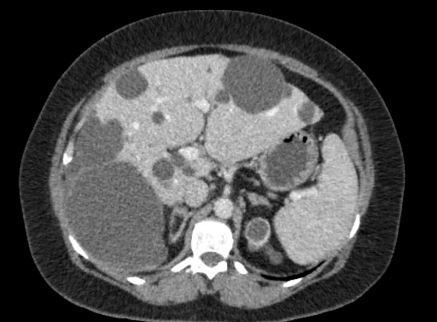 Autosomal dominant polycystic kidney disease (Radiopaedia 57124-64017 A 38).jpg