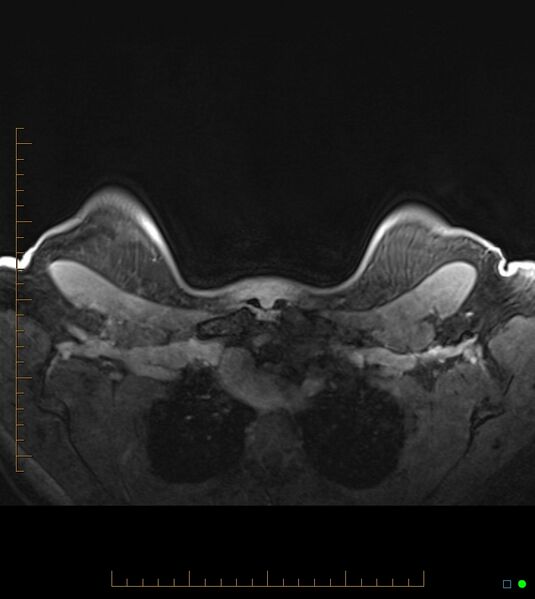 File:Axillary lymphadenopathy on breast MRI- yellow fever vaccination induced (Radiopaedia 19454-19483 Axial T1 C+ fat sat 6).jpg