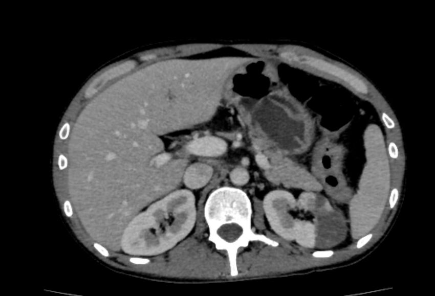 Behçet's disease- abdominal vasculitis (Radiopaedia 55955-62570 A 20).jpg
