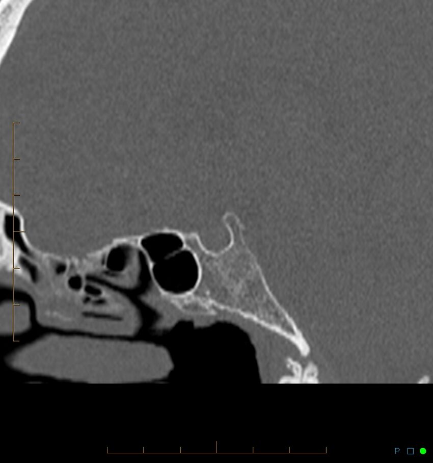 Benign notochordal cell tumor (probable) (Radiopaedia 65475-74546 Sagittal bone window 18).jpg