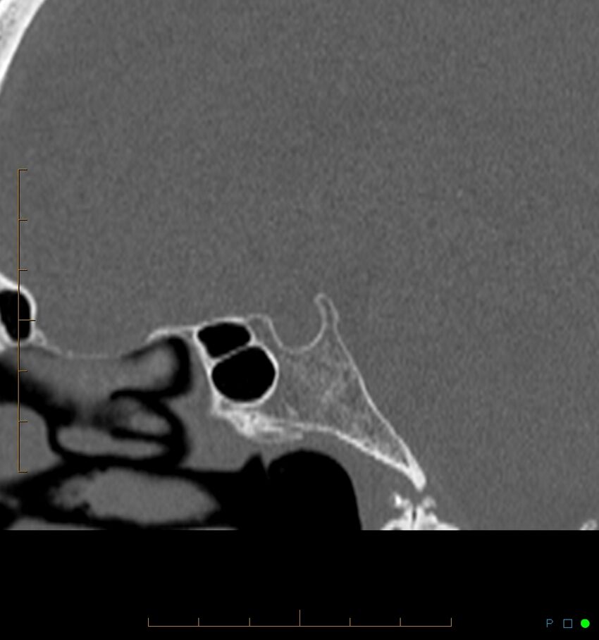 Benign notochordal cell tumor (probable) (Radiopaedia 65475-74546 Sagittal bone window 20).jpg