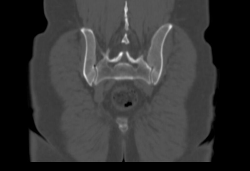 File:Bertolotti syndrome (Radiopaedia 58974-66235 Coronal bone window 6).jpg