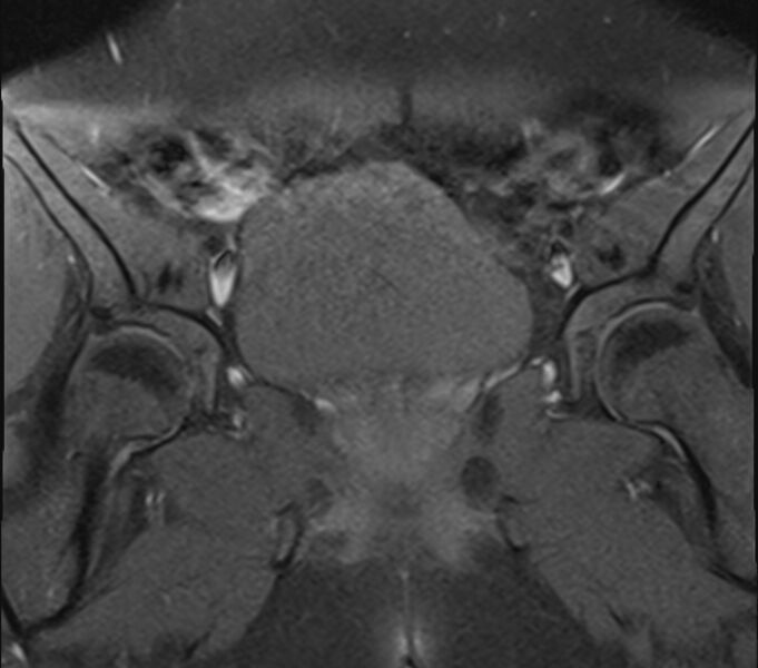 File:Bicornuate uterus (Radiopaedia 71214-81511 Coronal T1 fat sat 24).jpg
