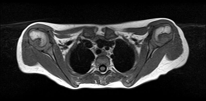 File:Bilateral Sprengel deformity with Klippel-Feil syndrome (Radiopaedia 66395-75650 Axial T1 23).jpg