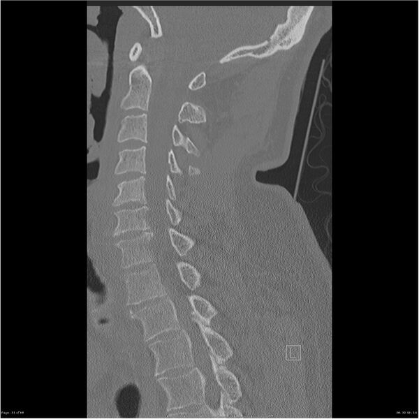 File:Bilateral cervical ribs (Radiopaedia 25868-26017 Sagittal bone window 31).jpg