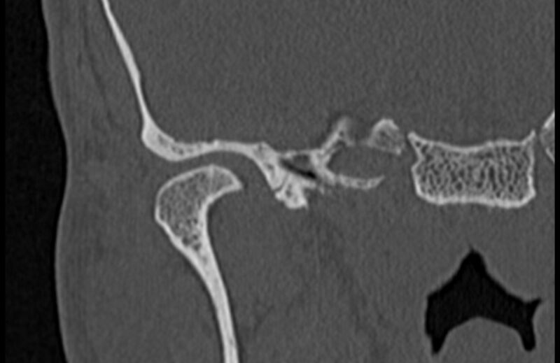 File:Bilateral cholesteatoma (Radiopaedia 54898-61172 Coronal bone window 5).jpg