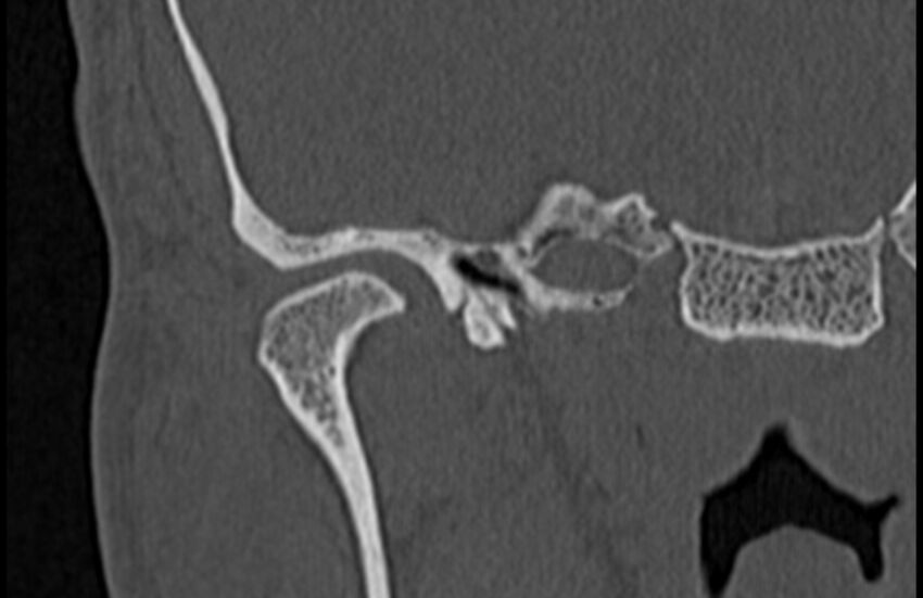 Bilateral cholesteatoma (Radiopaedia 54898-61172 Coronal bone window 7).jpg