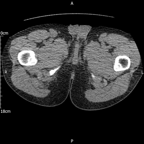 File:Bilateral medullary nephrocalcinosis with ureteric calculi (Radiopaedia 71269-81569 Axial non-contrast 151).jpg