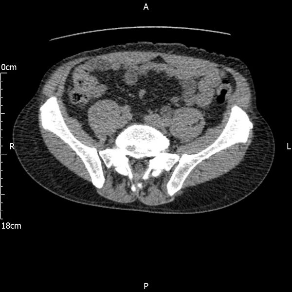 File:Bilateral medullary nephrocalcinosis with ureteric calculi (Radiopaedia 71269-81569 Axial non-contrast 92).jpg