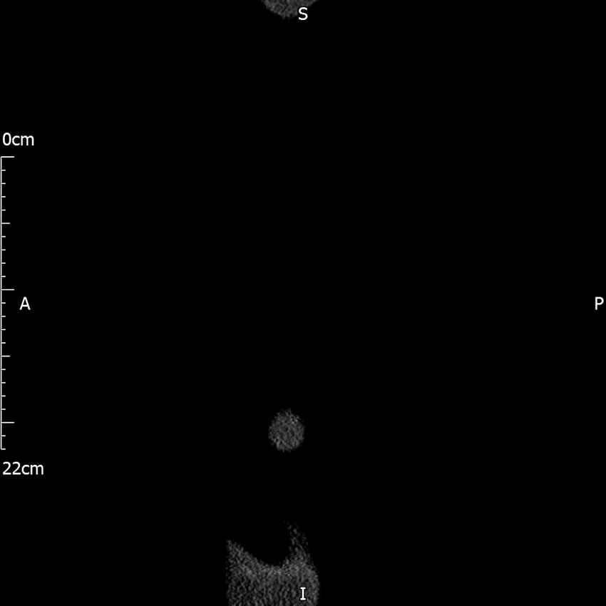 Bilateral medullary nephrocalcinosis with ureteric calculi (Radiopaedia 71269-81569 C 116).jpg