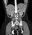 Bilateral ovarian mature cystic teratomas (Radiopaedia 79373-92457 B 72).jpg