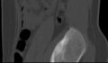 Bilateral pars defect (Radiopaedia 26691-26846 Sagittal bone window 60).jpg
