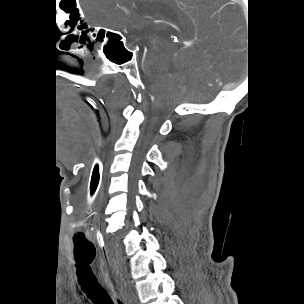 File:Bilateral perched facets with cord injury (Radiopaedia 45587-49713 B 22).jpg