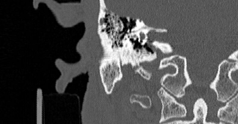 File:Bilateral temporal bone fractures (Radiopaedia 29482-29970 Coronal non-contrast 119).jpg